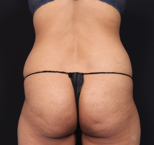 New Jersey Tummy Tuck Before & After Gallery - Patient 63839778 - Image 9