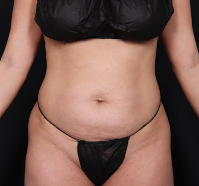 New Jersey Tummy Tuck Before & After Gallery - Patient 63839777 - Image 1