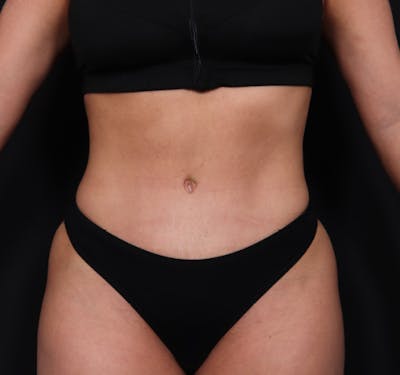 Tummy Tuck Before & After Gallery - Patient 63839777 - Image 2