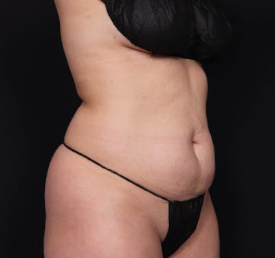 Tummy Tuck Before & After Gallery - Patient 63839777 - Image 3