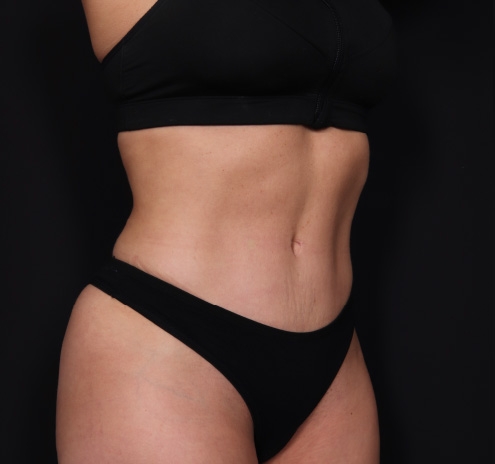 New Jersey Tummy Tuck Before & After Gallery - Patient 63839777 - Image 4