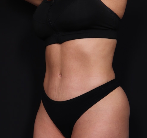 New Jersey Tummy Tuck Before & After Gallery - Patient 63839777 - Image 6