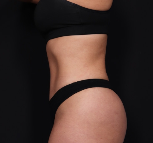 New Jersey Tummy Tuck Before & After Gallery - Patient 63839777 - Image 8