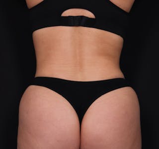 New Jersey Tummy Tuck Before & After Gallery - Patient 63839777 - Image 10