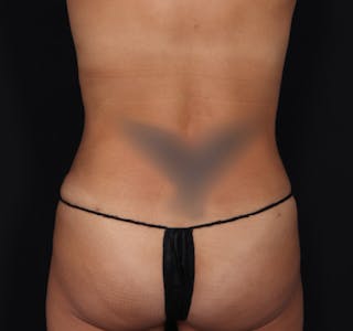 New Jersey Tummy Tuck Before & After Gallery - Patient 63839770 - Image 10