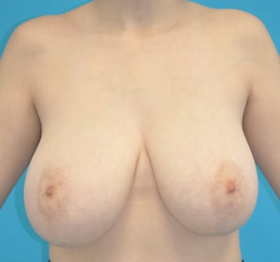 New Jersey Breast Reduction Before & After Gallery - Patient 63841071 - Image 1