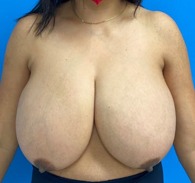 New Jersey Breast Reduction Before & After Gallery - Patient 63841074 - Image 1