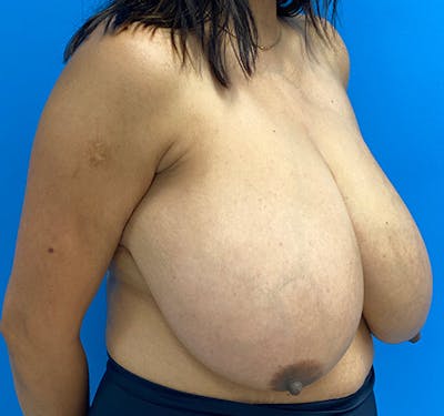 New Jersey Breast Reduction Before & After Gallery - Patient 63841074 - Image 3