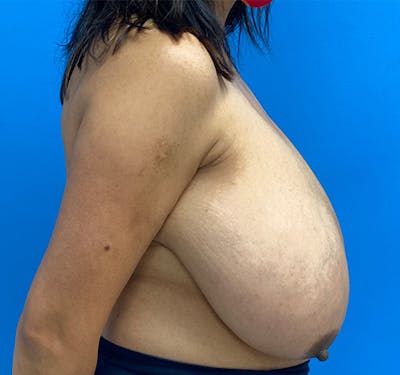 New Jersey Breast Reduction Before & After Gallery - Patient 63841074 - Image 5