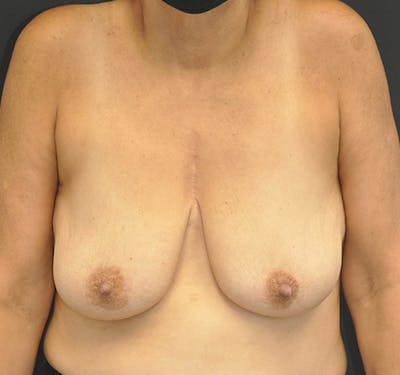 New Jersey Breast Reduction Before & After Gallery - Patient 63841072 - Image 1