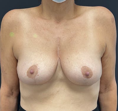 New Jersey Breast Reduction Before & After Gallery - Patient 63841072 - Image 2