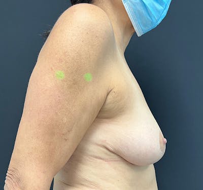 New Jersey Breast Reduction Before & After Gallery - Patient 63841072 - Image 6
