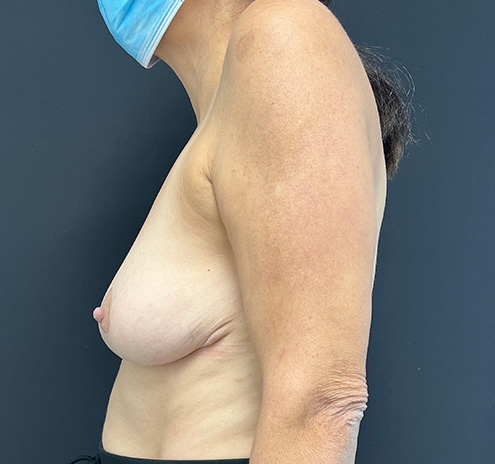 New Jersey Breast Reduction Before & After Gallery - Patient 63841072 - Image 10