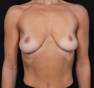 New Jersey Breast Augmentation Before & After Gallery - Patient 181785701 - Image 1