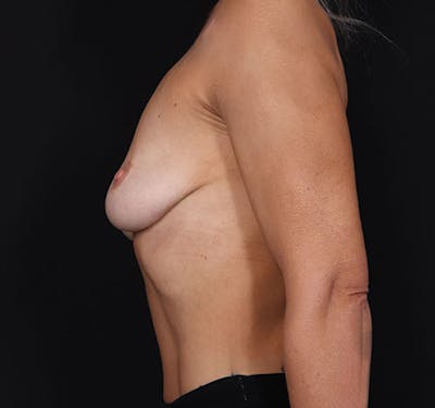 New Jersey Breast Augmentation Before & After Gallery - Patient 181785701 - Image 5