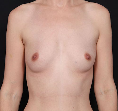 New Jersey Breast Augmentation Before & After Gallery - Patient 181785702 - Image 1