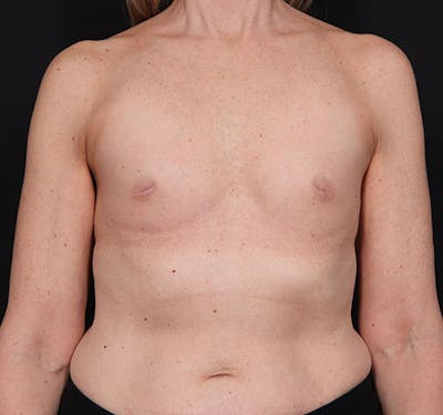 New Jersey Breast Augmentation Before & After Gallery - Patient 181785703 - Image 1