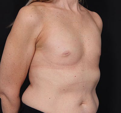 New Jersey Breast Augmentation Before & After Gallery - Patient 181785703 - Image 3