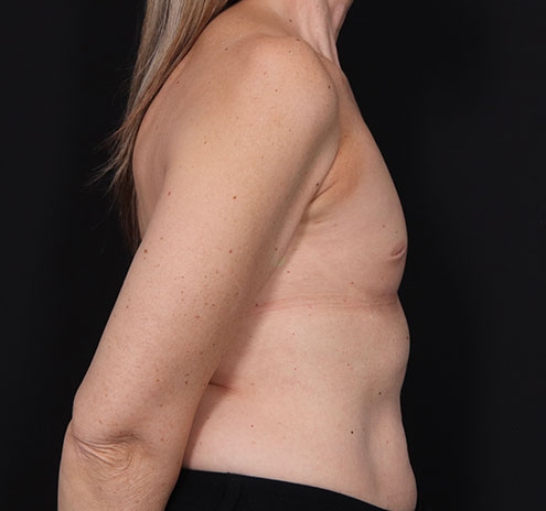 New Jersey Breast Augmentation Before & After Gallery - Patient 181785703 - Image 5