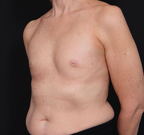 New Jersey Breast Augmentation Before & After Gallery - Patient 181785703 - Image 7