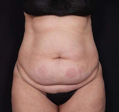 New Jersey Tummy Tuck Before & After Gallery - Patient 181785768 - Image 1