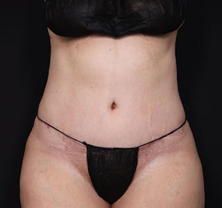 New Jersey Tummy Tuck Before & After Gallery - Patient 181785768 - Image 2