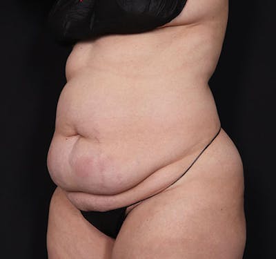 New Jersey Tummy Tuck Before & After Gallery - Patient 181785768 - Image 3