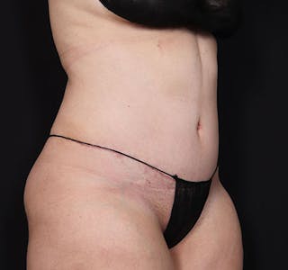 New Jersey Tummy Tuck Before & After Gallery - Patient 181785768 - Image 8