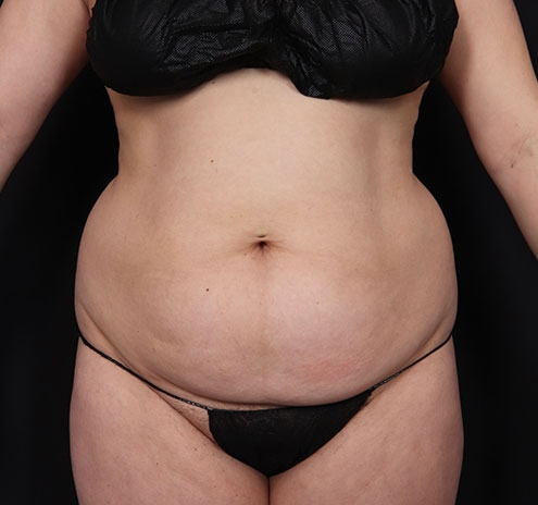 New Jersey Tummy Tuck Before & After Gallery - Patient 181785769 - Image 1