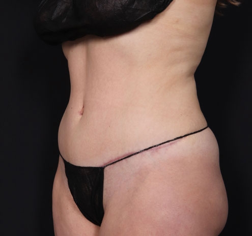 New Jersey Tummy Tuck Before & After Gallery - Patient 181785769 - Image 6
