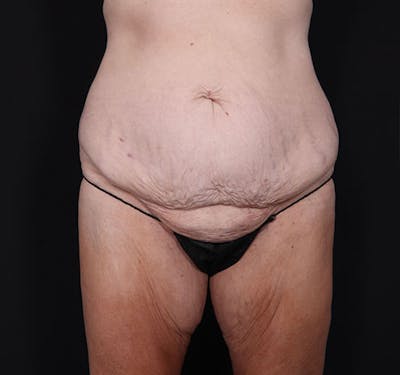 New Jersey Body Lift Before & After Gallery - Patient 181785904 - Image 1