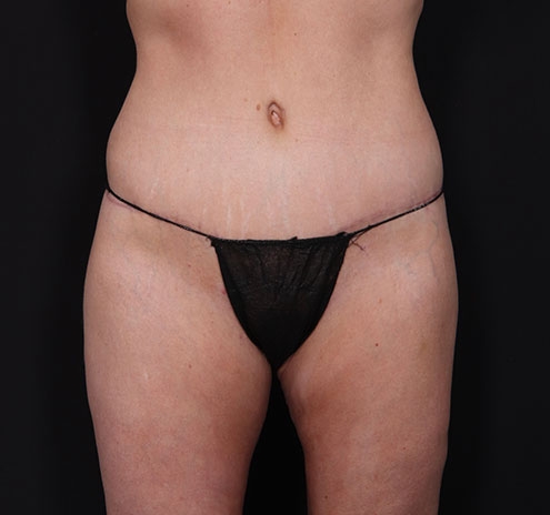 New Jersey Body Lift Before & After Gallery - Patient 181785904 - Image 2