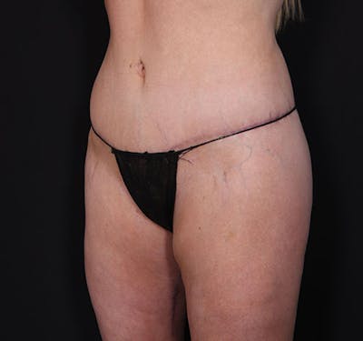 New Jersey Body Lift Before & After Gallery - Patient 181785904 - Image 4