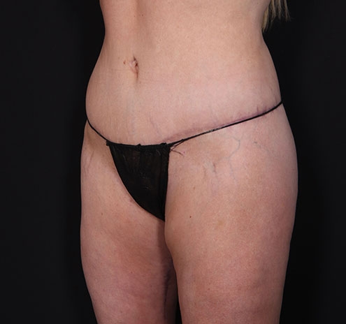 New Jersey Body Lift Before & After Gallery - Patient 181785904 - Image 4