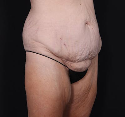 New Jersey Body Lift Before & After Gallery - Patient 181785904 - Image 5