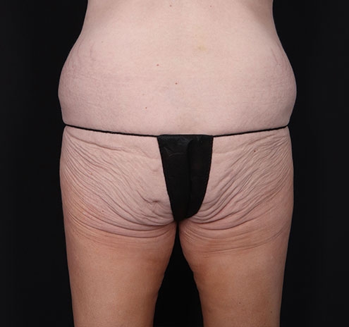 New Jersey Body Lift Before & After Gallery - Patient 181785904 - Image 7