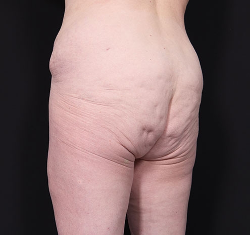 New Jersey Body Lift Before & After Gallery - Patient 181785904 - Image 9