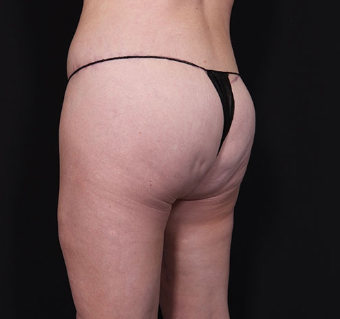 New Jersey Body Lift Before & After Gallery - Patient 181785904 - Image 10