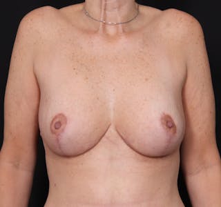 New Jersey Breast Lift (Mastopexy) Before & After Gallery - Patient 368985 - Image 2