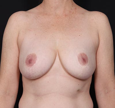 New Jersey Scar-Less Breast Reduction Before & After Gallery - Patient 356771 - Image 2