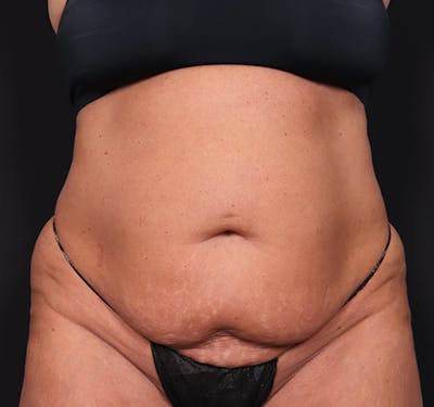 New Jersey Tummy Tuck Before & After Gallery - Patient 385862 - Image 1