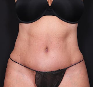 New Jersey Tummy Tuck Before & After Gallery - Patient 385862 - Image 2