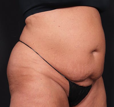 New Jersey Tummy Tuck Before & After Gallery - Patient 385862 - Image 3