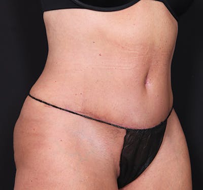 New Jersey Tummy Tuck Before & After Gallery - Patient 385862 - Image 4