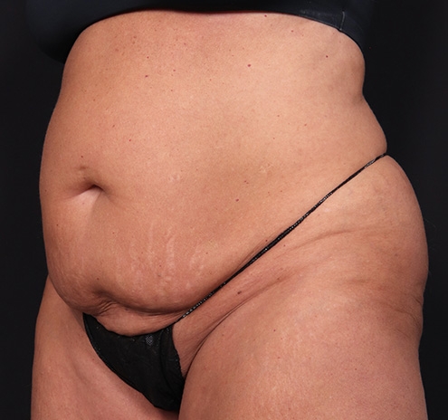 New Jersey Tummy Tuck Before & After Gallery - Patient 385862 - Image 5