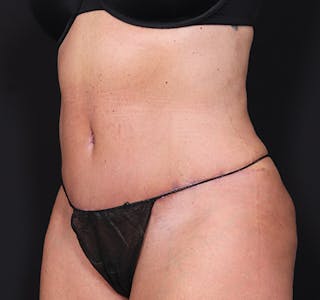 New Jersey Tummy Tuck Before & After Gallery - Patient 385862 - Image 6
