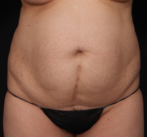 New Jersey Tummy Tuck Before & After Gallery - Patient 226616 - Image 1