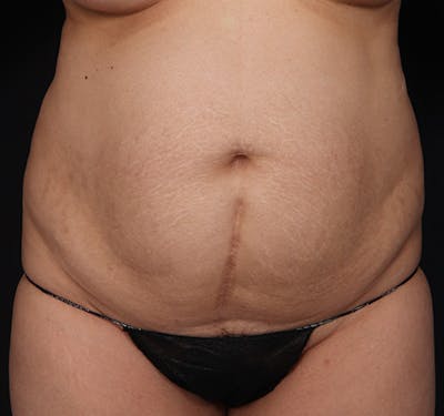 New Jersey Tummy Tuck Before & After Gallery - Patient 226616 - Image 1