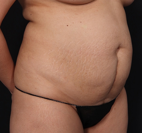 New Jersey Tummy Tuck Before & After Gallery - Patient 226616 - Image 3