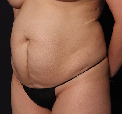 New Jersey Tummy Tuck Before & After Gallery - Patient 226616 - Image 5